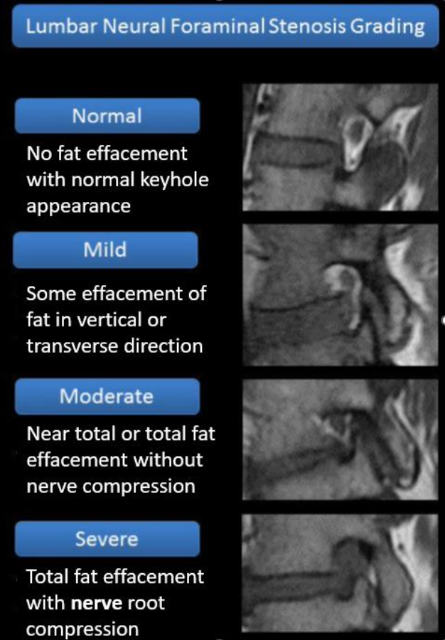 Neural-Foraminal-Narrowing-Severity.png